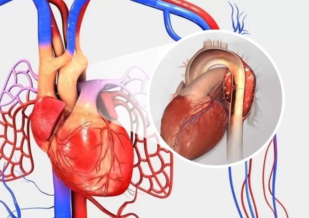 Aneurisma da Aorta Torácica: Causas, Sintomas, Tratamento